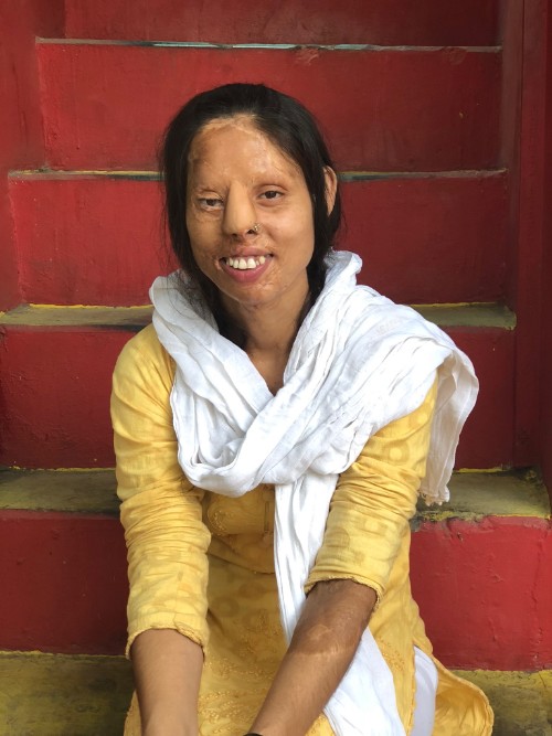 An acid-attack survivor smiles